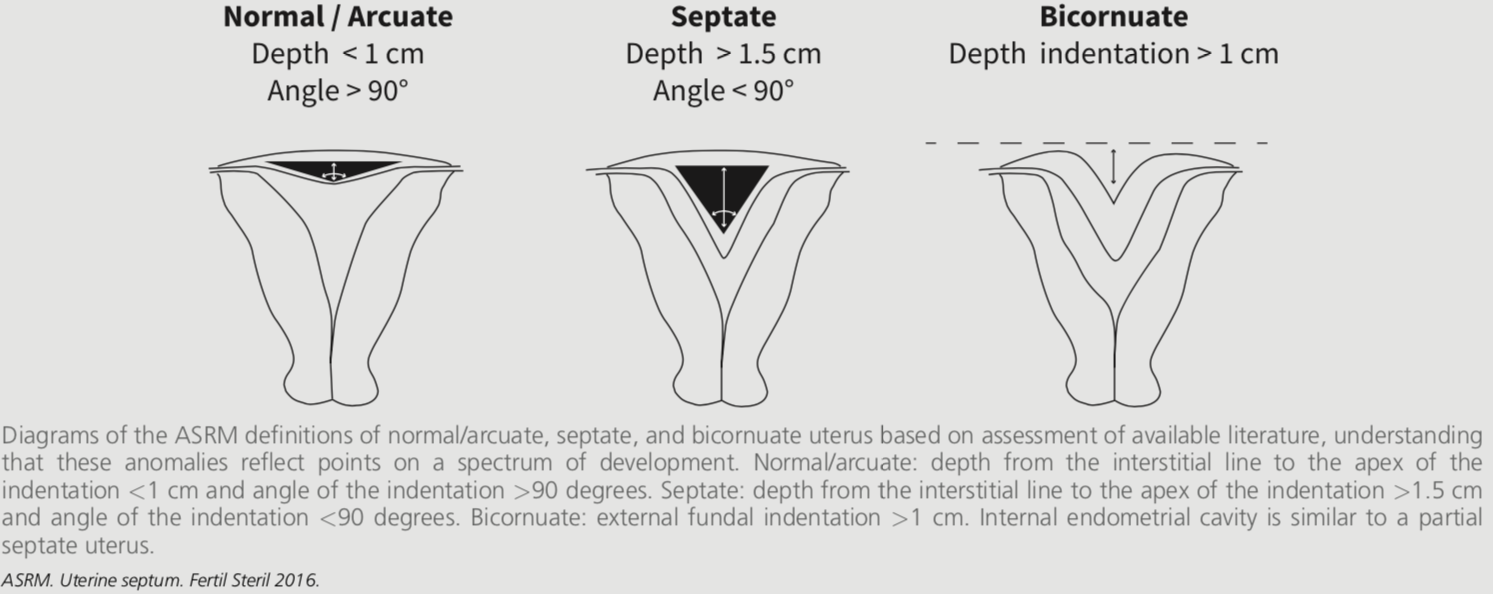 図2：正常、中隔子宮、双角子宮の分類
